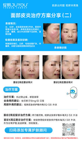 面部皮炎治疗方案分享（二）