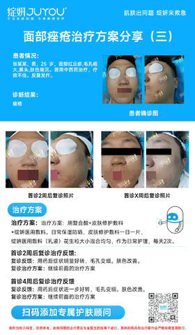 面部痤疮治疗方案分享（三）