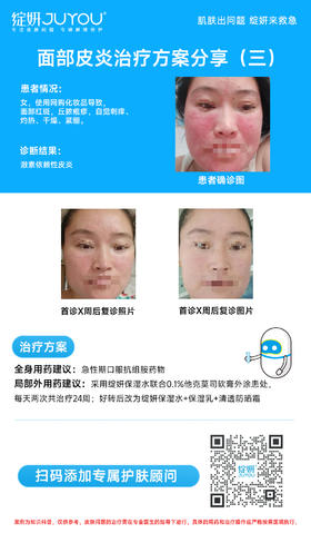 面部皮炎治疗方案分享（三）