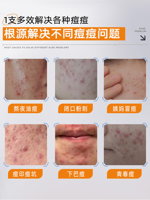 【国货之光】片仔癀牌祛痘膏 点痘笔祛痘修护膏深层修护淡化痘印 商品图3