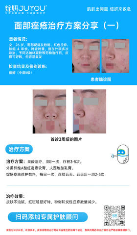 面部痤疮治疗方案分享（一）