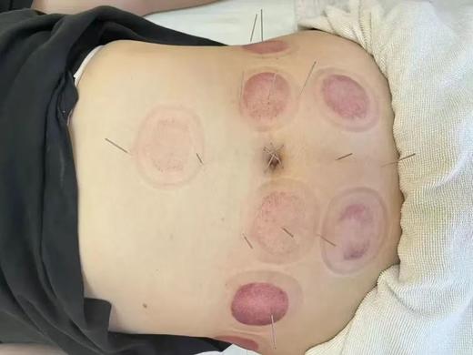 中医调理针灸 （仅到黄村社卫使用） 商品图0