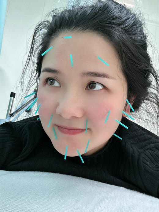 中医美容针灸 （仅到黄村社卫使用） 商品图0