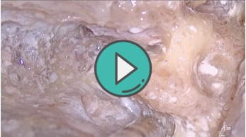 轮廓化半规管3D视频