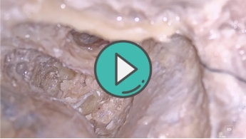 磨开半规管3D视频