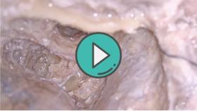 磨开半规管3D视频