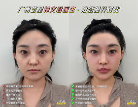 【钟文君】案例-液态提升对比