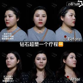 【余时间】超塑面部+下颌缘双下巴