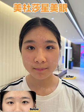 【曾繁茂】美杜莎美眼案例