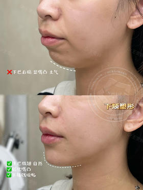 【王雯婷】院长-下巴打造