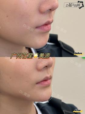 【黄源】主任-下巴填充