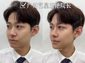 【王艳】院长案例-男士NBS气质微整