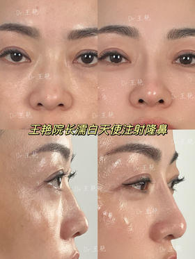 【王艳】院长案例 濡白天使注射隆鼻