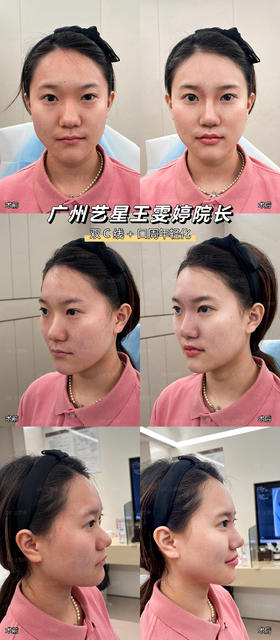 【王雯婷】鼻+唇 双C线+口周年轻化