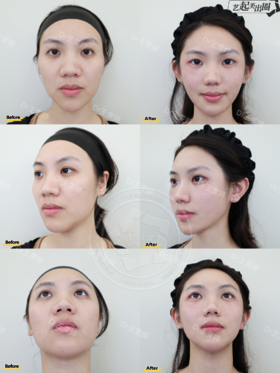 【王雯婷】-气质蝴蝶面眉弓打造