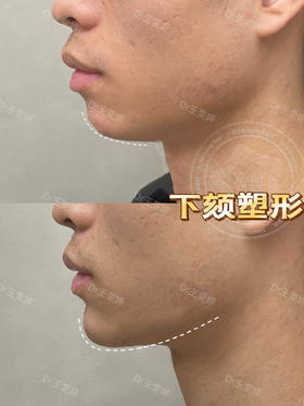 【王雯婷】院长-下颌塑形