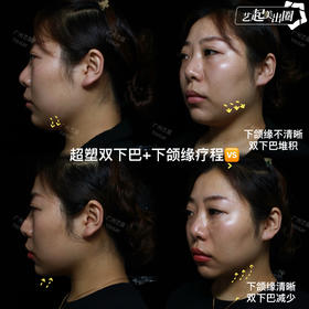 【余时间】案例-超塑双下巴+下颌缘