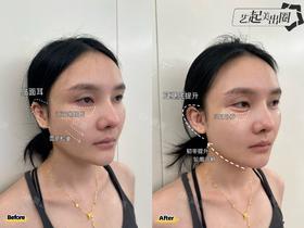 【黄源】主任-耳基底提升