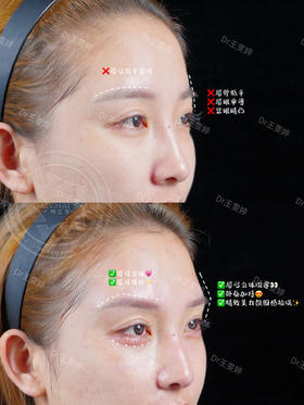 【王雯婷】-卧蚕＋眉弓固定