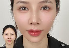【王艳】院长案例 kiss me泛口周年轻化 +恋恋桃花眼