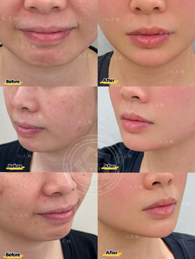 【王艳】院长-玻尿酸隆下巴