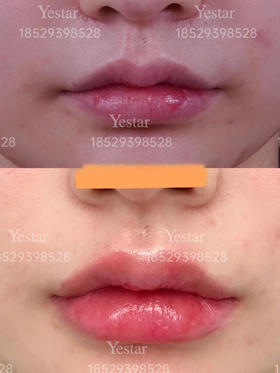 【王艳】院长案例 kiss me泛口周年轻化