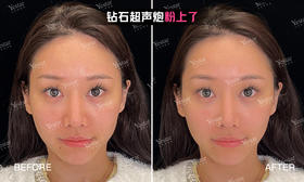 【朱虹】案例-钻石超声炮