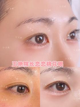 【王艳】院长 恋恋桃花眼案例对比