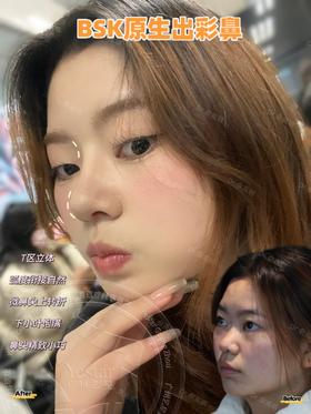 【佘高明】半肋鼻综合案例