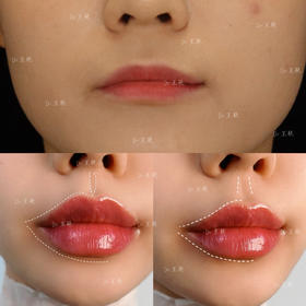 【王艳】院长案例 kiss me泛口周年轻化