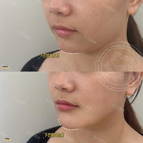 【王雯婷】-下巴打造