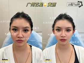 【黄源】主任-耳基底提升