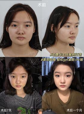 【邓晟华】面部吸脂案例