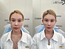 【黄源】主任-耳基底提升