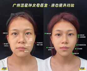 【钟文君】案例-液态提升对比