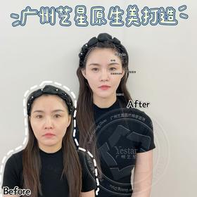 【钟文君】主任-耳基底提升