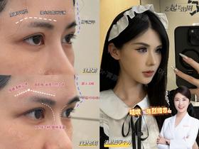 【黄源】主任-眉弓注射