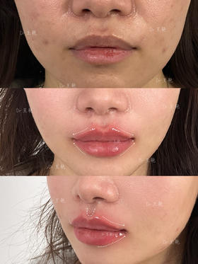 【王艳】院长案例 kiss me泛口周年轻化 