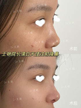 【王艳】院长案例 濡白天使注射隆鼻
