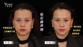 【朱虹】案例-钻石超声炮对比图