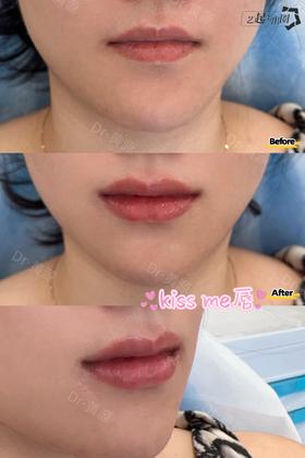 【黄源】主任-玻尿酸丰唇