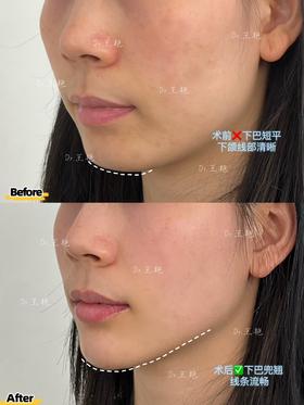 【王艳】院长-下巴提升