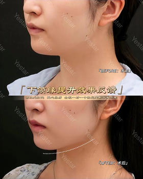 【邓晟华】面部吸脂 下颌线提升案例