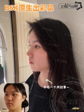 【佘高明】半肋鼻综合案例