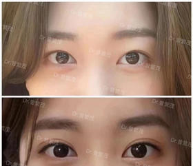 【曾繁茂】院长-新增眼部对比图