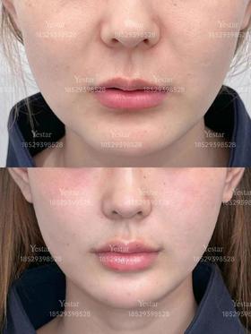 【王艳】院长案例 kiss me泛口周年轻化