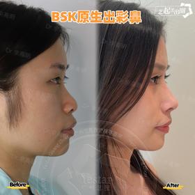 【佘高明】半肋鼻综合案例