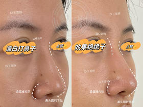 【王雯婷】-濡白天使注射隆鼻