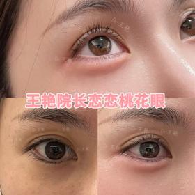 【王艳】院长 恋恋桃花眼案例对比