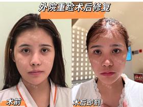 【曾繁茂】案例-外院重脸术后修复